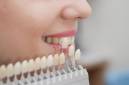 виды протезирования зубов, качественное протезирование зубов